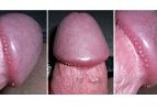 duong-vat-noi-mun-la-benh-gi-ts-bac-si-le-van-hot-hon-40-nam-chua-benh-nam-khoa-chia-se